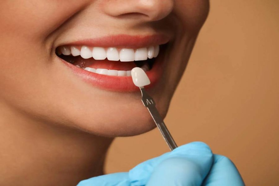 All about Celebrity veneers