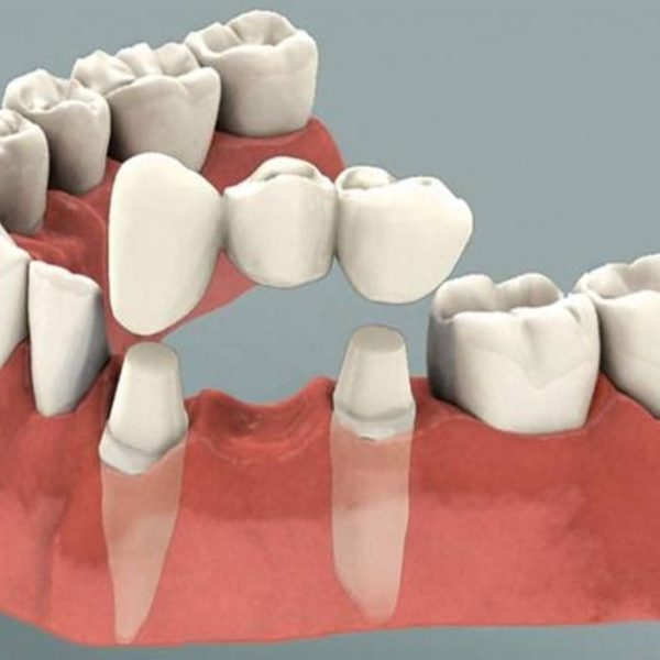 خدمات دندانپزشکی در تورنتو - روکش و بریج دندان