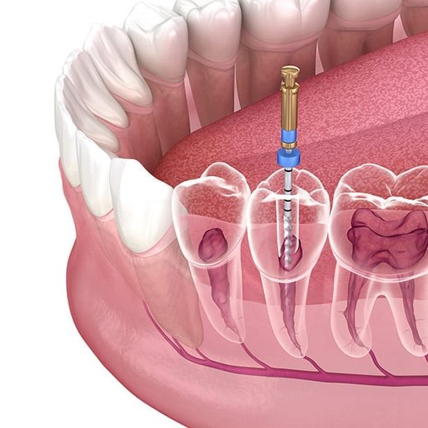 خدمات دندانپزشکی اورژانسی در تورنتو - عصب کشی